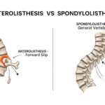 anterolisthesis vs spondylolisthesis