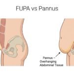 fupa vs pannus